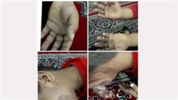 جزئیات شکنجه دانش آموز ایلامی توسط معلم / تمام بدن ابوالفضل کبود شده + عکس