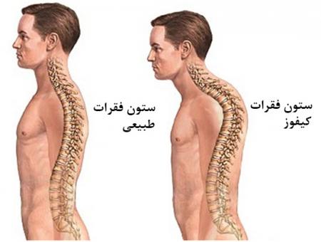 عوارض کیفوز گردن و کمر/ بلایی که  کیفوز می تواند سرتان بیاورد