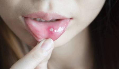 درمان سریع آفت دهان با یک روش سنتی