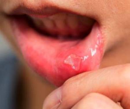 درمان زخم با آب دهان واقعا ممکن است؟