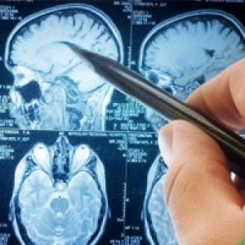 فشار خون بالا و دیابت در میانسالی ساختار مغز را تغییر می دهد فشار خون بالا و دیابت در میانسالی ساختار مغز را تغییر می دهد