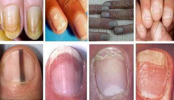 حواستان به هشدارهایی که ناخن هایتان از سرطان میدهد باشد