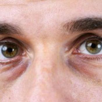 ۶ علت تیرگی زیر چشم ها