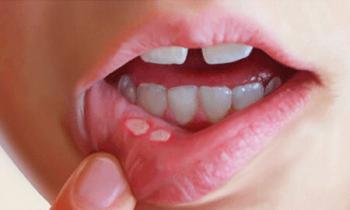 تاثیر یک پروتئین بر آفت دهان