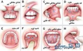 شایع‌ترین علامت ابتلا به سرطان دهان و زبان