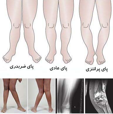 پا پرانتزی شدن کودکان چه دلایلی دارد؟ پا پرانتزی شدن کودکان چه دلایلی دارد؟