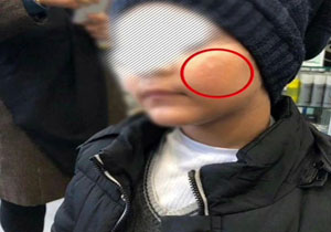 ماجرای سوزاندن صورت یک پسر بچه با کفگیر در مهد کودک رامسر؟ ماجرای سوزاندن صورت یک پسر بچه با کفگیر در مهد کودک رامسر؟