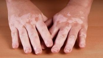 وجود ملانین در بدن چه مزایا و معایبی دارد؟ وجود ملانین در بدن چه مزایا و معایبی دارد؟