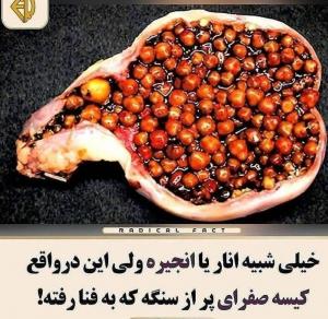 عکسی از کیسه پر از سنگ صفرا / این بیماری را جدی بگیرید